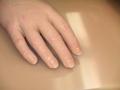 Kosmetická předloketní protéza -standardní řešení tzv.kosmetickou rukavicí